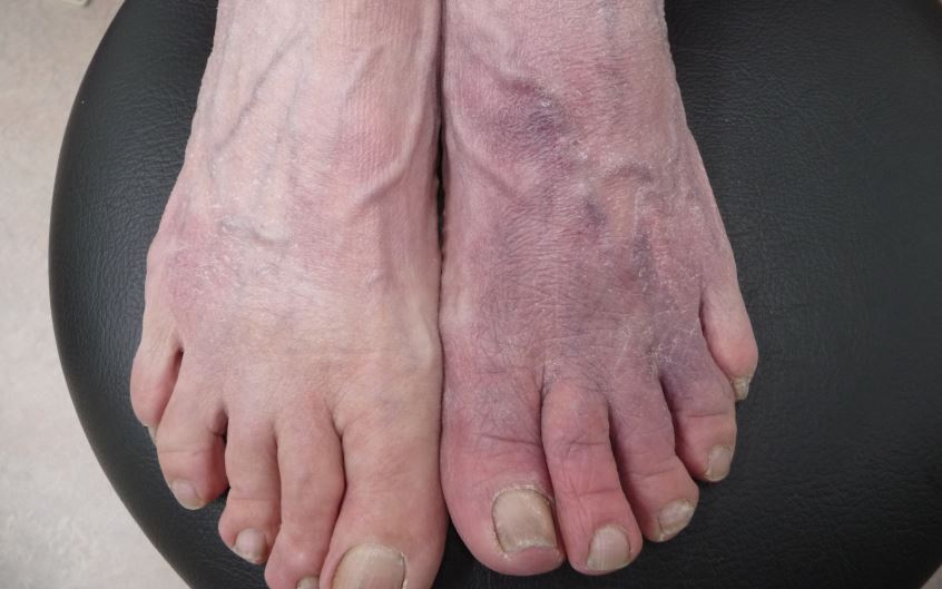 lavendel ziekte Leidinggevende Een paarsrode kleur aan de voeten kan meerdere oorzaken hebben - Podopost