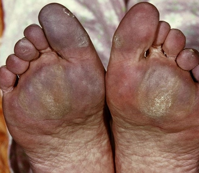 genie Rodeo informatie Dermatologie: Oorzaken van blauwe verkleuringen aan de voet - Podopost